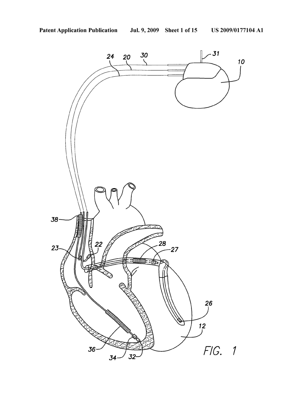 System and Method for Distinguishing Among Cardiac Ischemia, Hypoglycemia and Hyperglycemia Using an Implantable Medical Device - diagram, schematic, and image 02