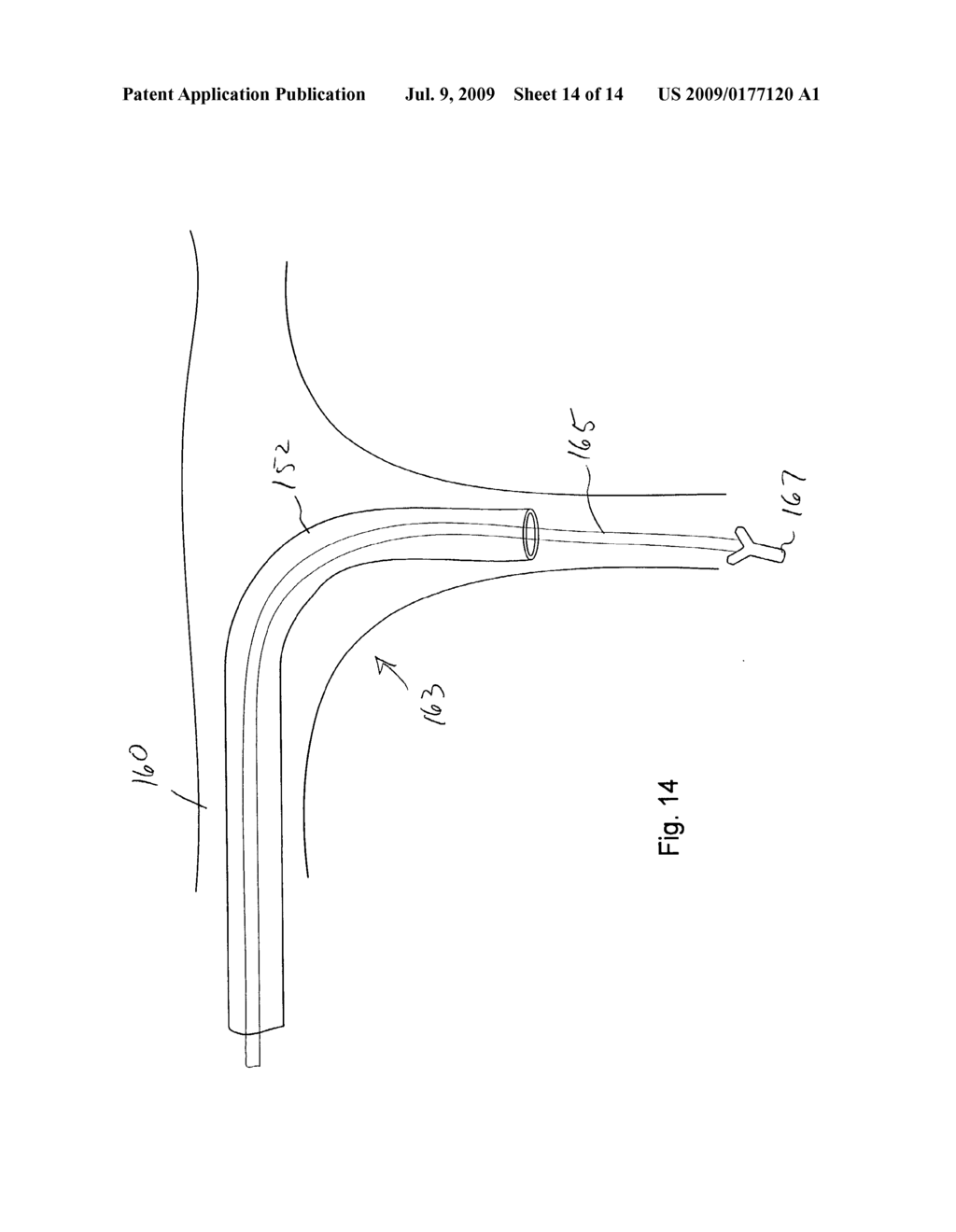 CORONARY VEIN NAVIGATOR - diagram, schematic, and image 15