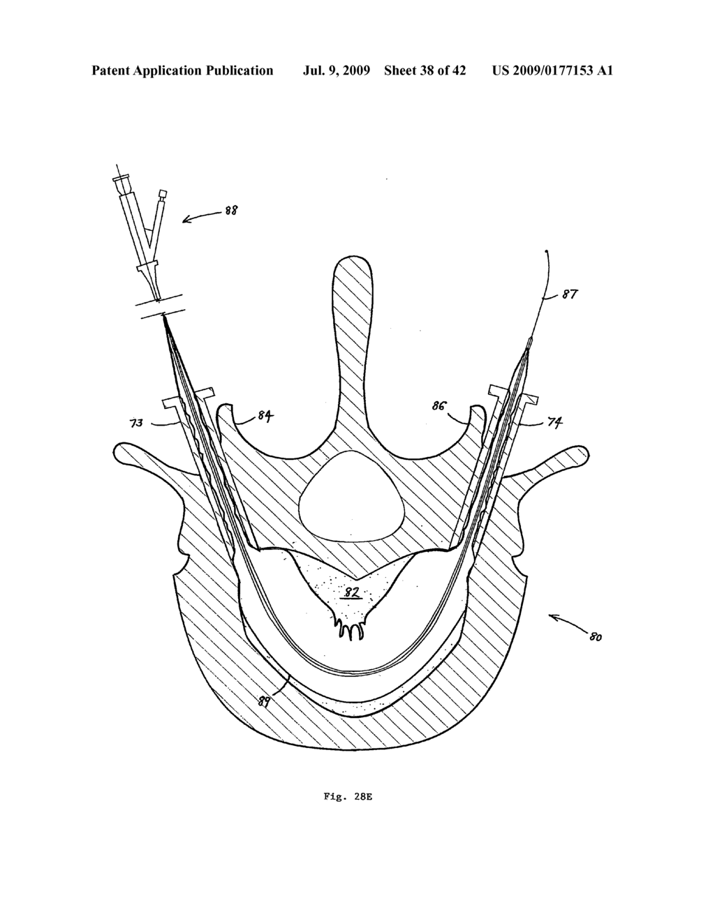 Apparatus and methods for bone, tissue and duct dilatation - diagram, schematic, and image 39