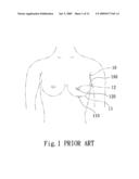 Silicon breast implant injector for augmentation mammaplasty diagram and image