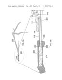 Apparatus and Methods for Separating Internal Bone Fixation Device from Introducer diagram and image