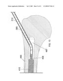 Apparatus and Methods for Separating Internal Bone Fixation Device from Introducer diagram and image