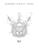 INSTRUMENTS, IMPLANTS, AND METHODS FOR FIXATION OF VERTEBRAL COMPRESSION FRACTURES diagram and image