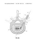 INSTRUMENTS, IMPLANTS, AND METHODS FOR FIXATION OF VERTEBRAL COMPRESSION FRACTURES diagram and image