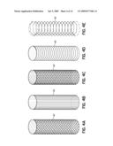 INSTRUMENTS, IMPLANTS, AND METHODS FOR FIXATION OF VERTEBRAL COMPRESSION FRACTURES diagram and image