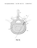 INSTRUMENTS, IMPLANTS, AND METHODS FOR FIXATION OF VERTEBRAL COMPRESSION FRACTURES diagram and image