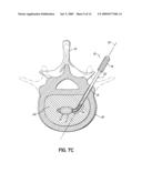 INSTRUMENTS, IMPLANTS, AND METHODS FOR FIXATION OF VERTEBRAL COMPRESSION FRACTURES diagram and image