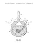 INSTRUMENTS, IMPLANTS, AND METHODS FOR FIXATION OF VERTEBRAL COMPRESSION FRACTURES diagram and image