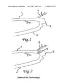 Endovascular implant for occlusion of a blood vessel diagram and image