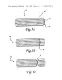 Endovascular implant for occlusion of a blood vessel diagram and image