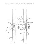 Endovascular implant for occlusion of a blood vessel diagram and image