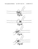 Endovascular implant for occlusion of a blood vessel diagram and image