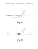 Endovascular implant for occlusion of a blood vessel diagram and image