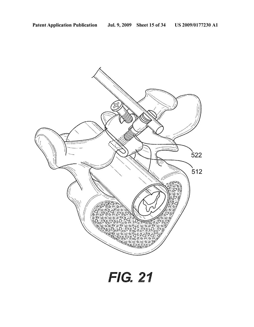 OSTEOINTEGRATION APPARATUS - diagram, schematic, and image 16