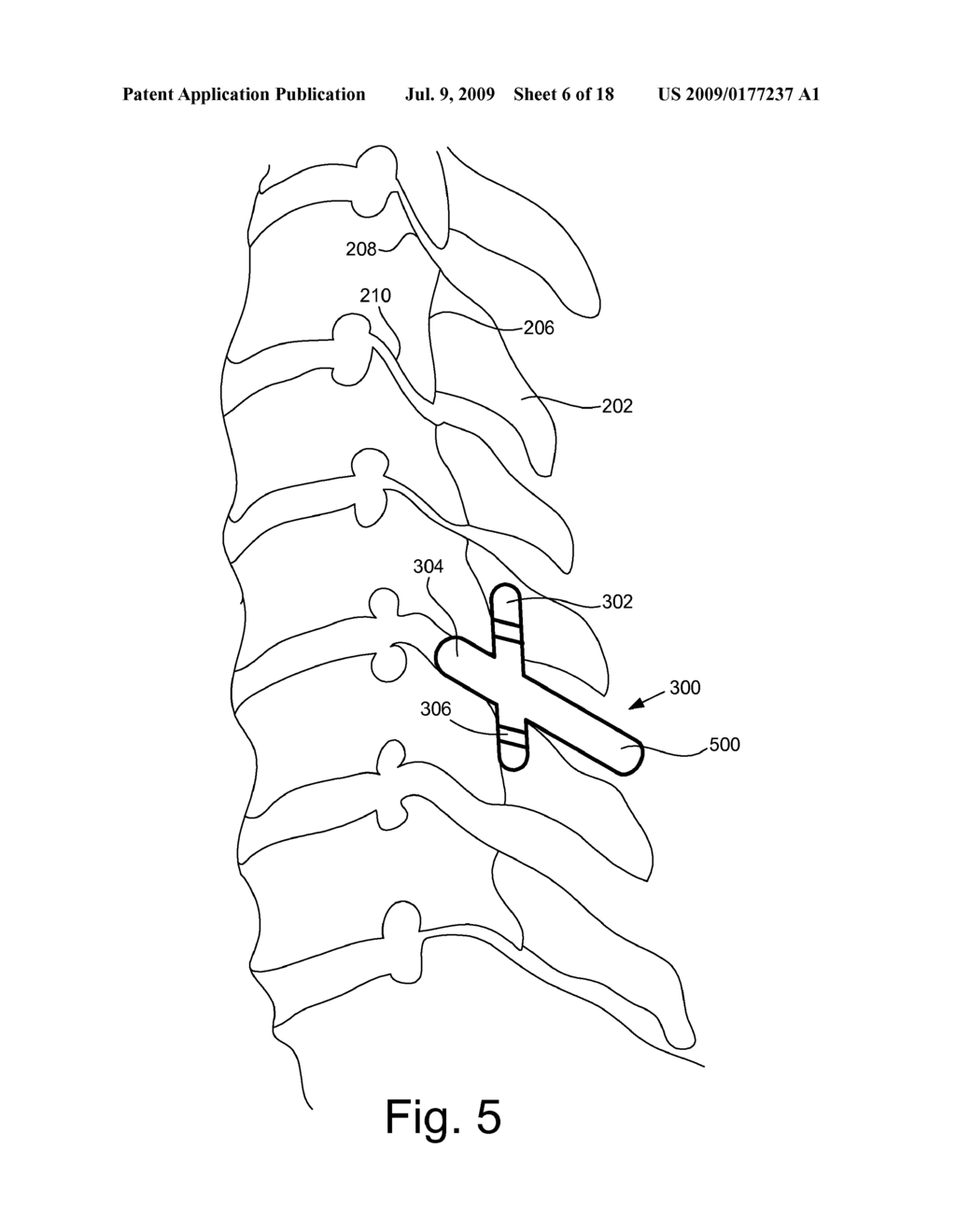 CERVICAL SPINE IMPLANT SYSTEM AND METHOD - diagram, schematic, and image 07
