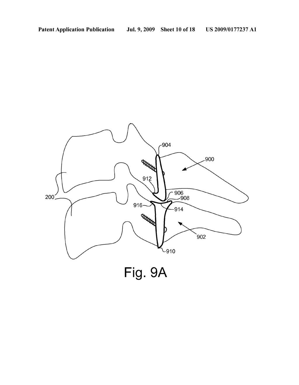 CERVICAL SPINE IMPLANT SYSTEM AND METHOD - diagram, schematic, and image 11