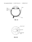 SUBCHOROIDAL RETINAL PROSTHESIS diagram and image