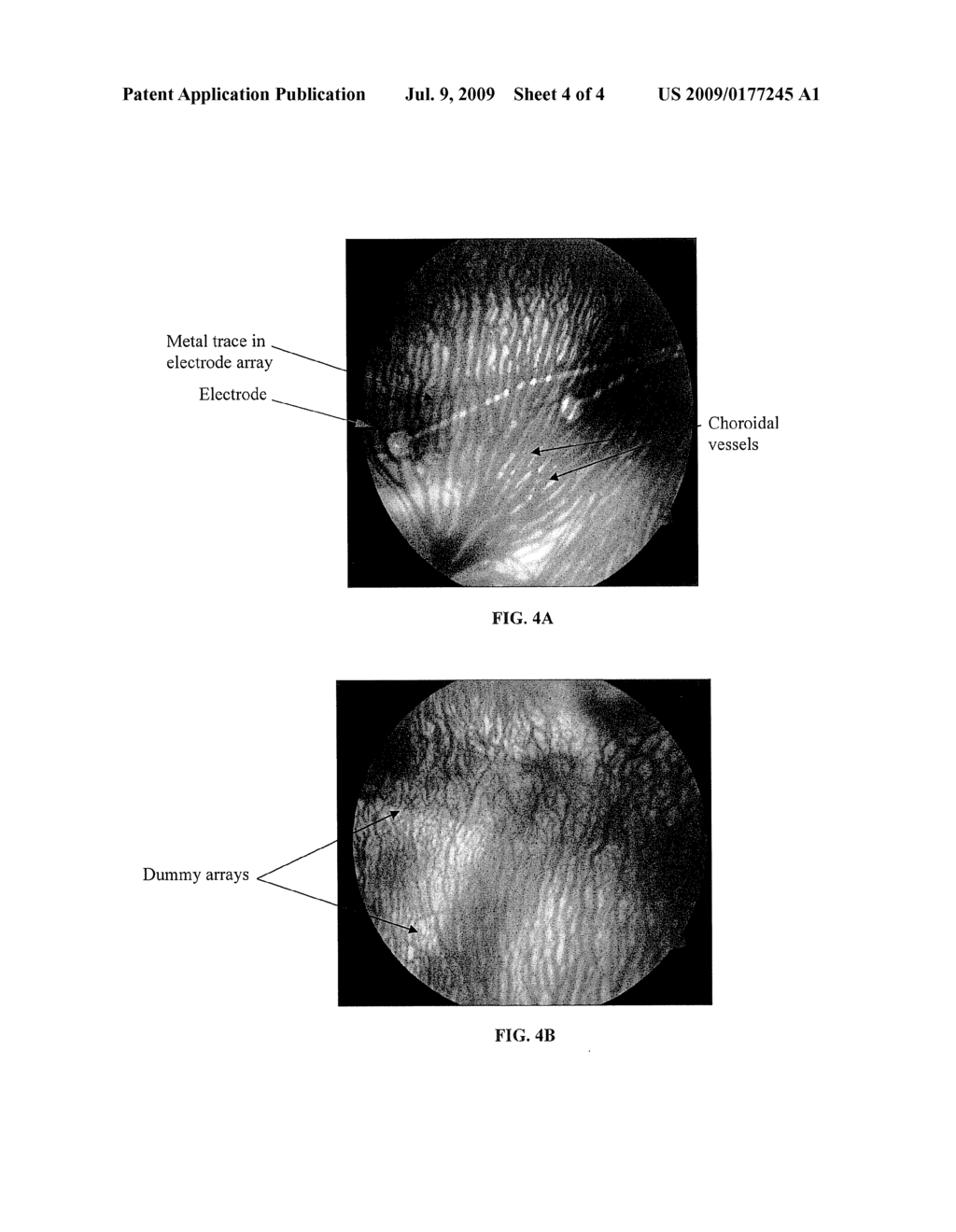 SUBCHOROIDAL RETINAL PROSTHESIS - diagram, schematic, and image 05