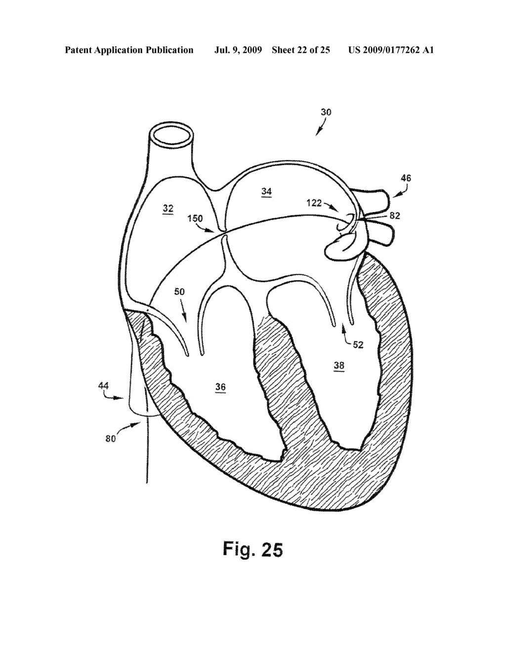 APPARATUS AND METHOD FOR TREATING CARDIOVASCULAR DISEASES - diagram, schematic, and image 23