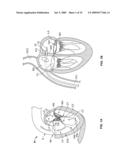 METHODS, SYSTEMS AND DEVICES FOR CARDIAC VALVE REPAIR diagram and image