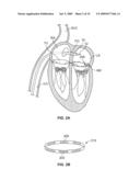 METHODS, SYSTEMS AND DEVICES FOR CARDIAC VALVE REPAIR diagram and image