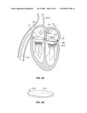 METHODS, SYSTEMS AND DEVICES FOR CARDIAC VALVE REPAIR diagram and image