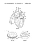 METHODS, SYSTEMS AND DEVICES FOR CARDIAC VALVE REPAIR diagram and image