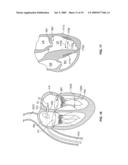 METHODS, SYSTEMS AND DEVICES FOR CARDIAC VALVE REPAIR diagram and image