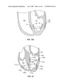 METHODS, SYSTEMS AND DEVICES FOR CARDIAC VALVE REPAIR diagram and image