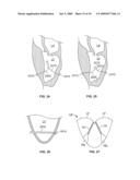 METHODS, SYSTEMS AND DEVICES FOR CARDIAC VALVE REPAIR diagram and image