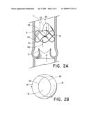 Flow-Deflecting Prosthesis for Treating Venous Disease diagram and image