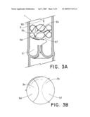 Flow-Deflecting Prosthesis for Treating Venous Disease diagram and image