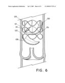 Flow-Deflecting Prosthesis for Treating Venous Disease diagram and image