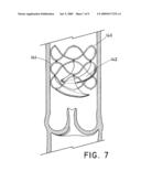 Flow-Deflecting Prosthesis for Treating Venous Disease diagram and image