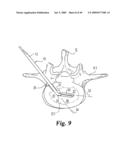 Devices and techniques for a posterior lateral disc space approach diagram and image