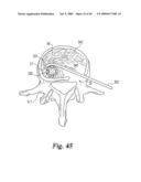 Devices and techniques for a posterior lateral disc space approach diagram and image