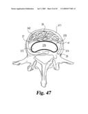 Devices and techniques for a posterior lateral disc space approach diagram and image