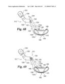 Devices and techniques for a posterior lateral disc space approach diagram and image