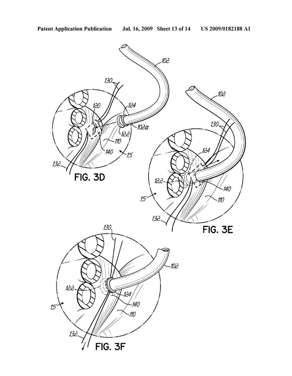 DEVICES, METHODS AND SYSTEMS FOR ESTABLISHING SUPPLEMENTAL BLOOD FLOW IN THE CIRCULATORY SYSTEM - diagram, schematic, and image 14