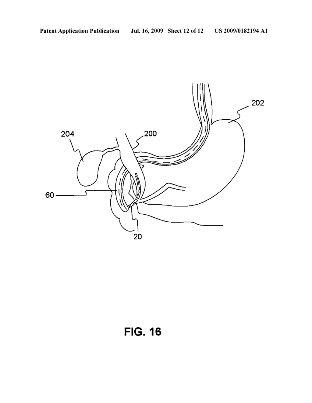 Positioning system for securing a treatment instrument at the end of a medical device - diagram, schematic, and image 13