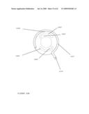 TROCAR STABILITY ASSEMBLY diagram and image