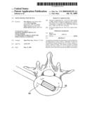 Tissue Distraction Device diagram and image