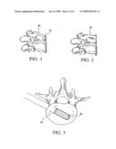 Tissue Distraction Device diagram and image