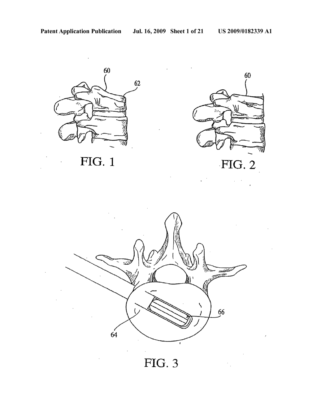 Tissue Distraction Device - diagram, schematic, and image 02