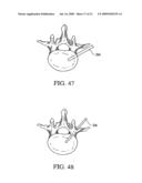 Tissue Distraction Device diagram and image