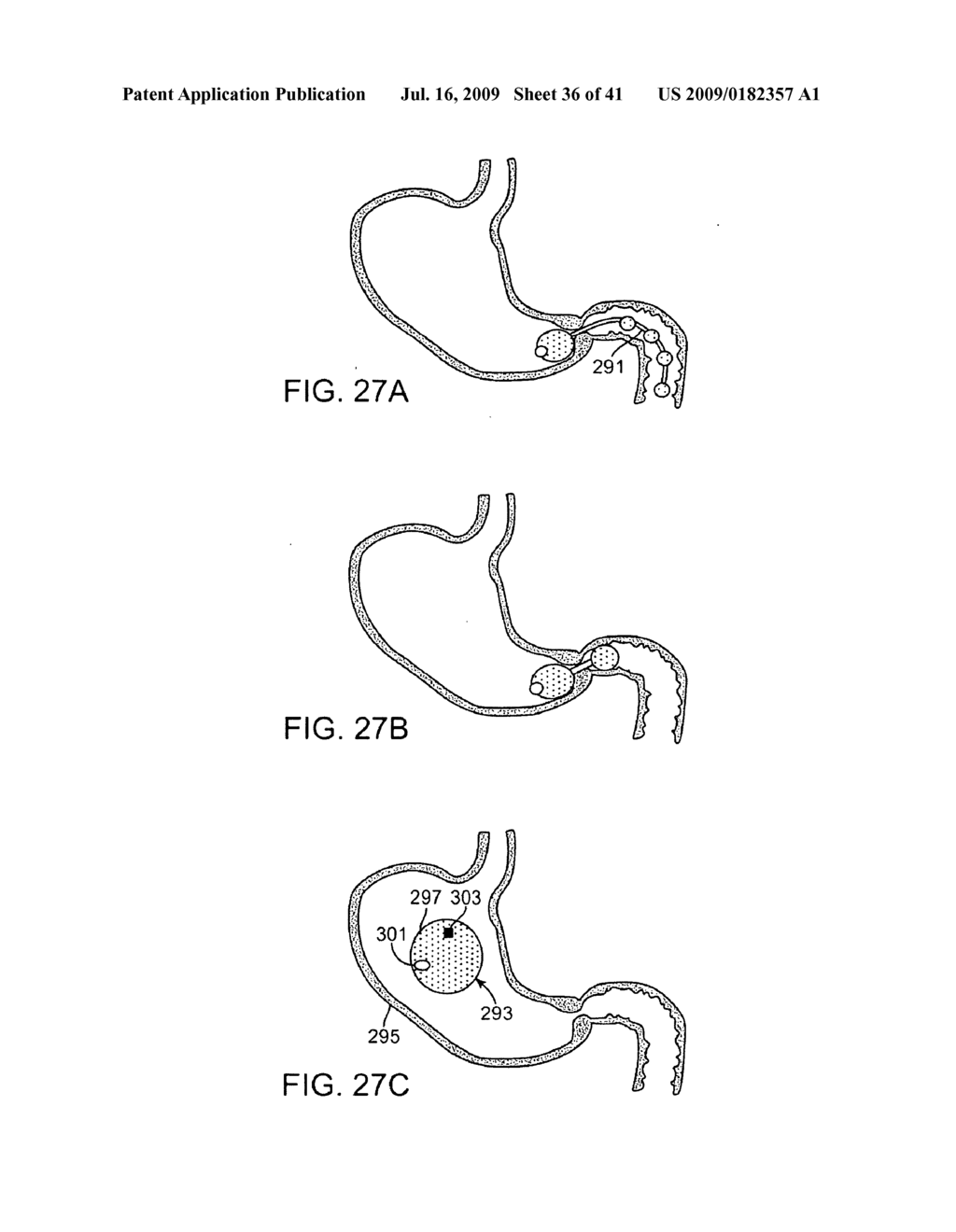 DEVICE FOR INTERMITTENTLY OBSTRUCTING A GASTRIC OPENING AND METHOD OF USE - diagram, schematic, and image 37