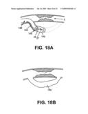 Device, System and Method for Interstitial Transvascular Intervention diagram and image