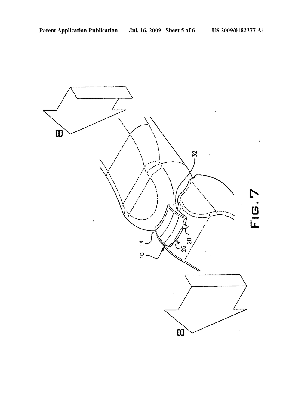 IMPLANT DEVICE USED IN MINIMALLY INVASIVE FACET JOINT HEMI-ARTHROPLASTY - diagram, schematic, and image 06