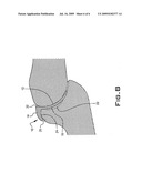 IMPLANT DEVICE USED IN MINIMALLY INVASIVE FACET JOINT HEMI-ARTHROPLASTY diagram and image