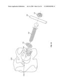 SPRING-LOADED DYNAMIC PEDICLE SCREW ASSEMBLY diagram and image